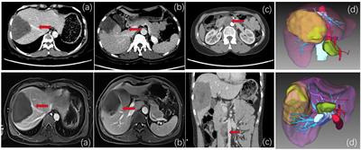 Treatment of Complicated Hepatic Alveolar Echinococcosis Disease With Suspicious Lymph Node Remote Metastasis Near the Inferior Vena Cava-Abdominal Aorta: A Case Report and Literature Review